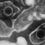 3- La mononucleosis infecciosa es provocada por el virus de Epstein Barr