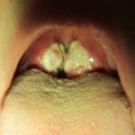 4- La mononucleosis infecciosa puede provocar un dolor de garganta severo
