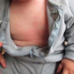 3- Las ronchas y las erupciones cutáneas es uno de los síntomas de la alergia a las proteínas de la leche