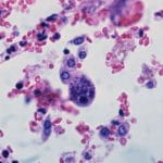 5- Citomegalovirus